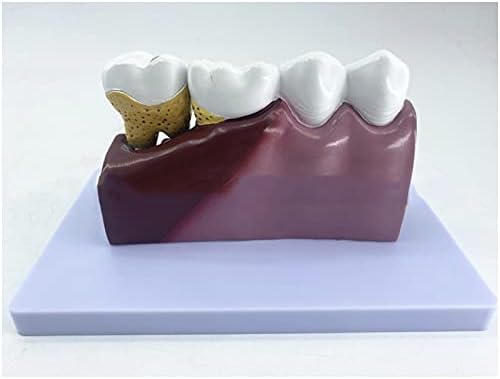 KH66ZKY Долен моларен анатомски модел - модел на стоматолошка патологија - со кариес, стоматолошки нерв, многу детално, зголемување 6 x