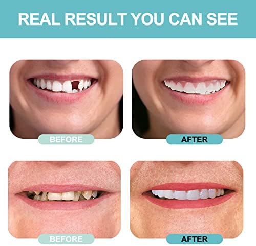 Лажни заби, протези заби за жени и мажи, стоматолошки фурнири за привремена реставрација на забите, природа и удобно, заштитете ги забите и ја враќаат самоуверената