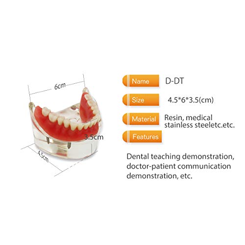 Модел на стоматолошки заби, максиларна мандибуларнатранспарентна стоматолошка имплантација на заби