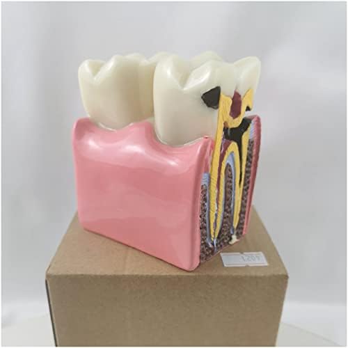 KH66ZKY Стоматолошки стандарден модел на заби - 6 пати заби за заби Компаративна студија модел - Споредба на патологијата на забите модел за предавање на студирање