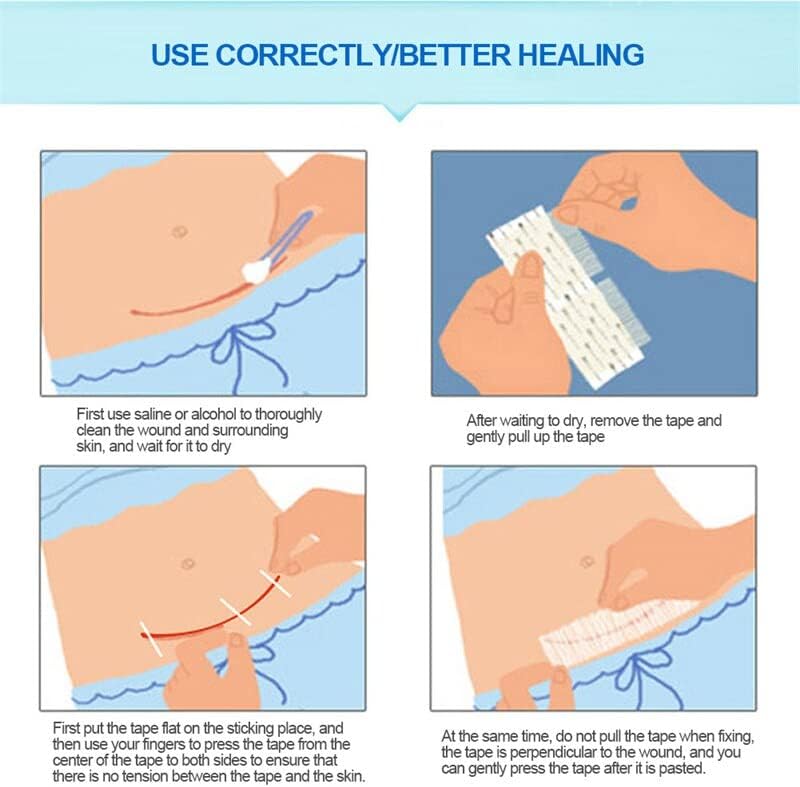 2-6 п.п. Беспрекорна операција на лента за чешлање Постпартална рана на кожата на затегнување на затегнување на безбедносна